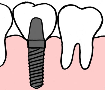 Implantat med en krone