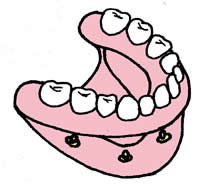 Aftagelig bro på implantater